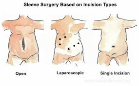 Woman left with horrific scars and deformed stomach after catching. One Incision Gastric Sleeve In Guadalajara Sils In Mexico Gastric Sleeve Surgery