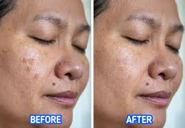 However, you may want to get rid of skin pigmentation or dark spots that may appear in your face, neck pigmentation in the skin causes dark brown patches and uneven skin tone thus making it look dull and lifeless. What Causes Skin Pigmentation And 4 Ways To Avoid It