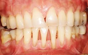 Take some turmeric and pepper and mix them together in a bowl. Treatments For Loose Teeth From Milton Keynes Dentist