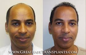 Dr Brett Bolton Hair Transplants Reviews by Ryan Excellent Hair Implant  Physician in Utah Salt Lake Panorama Apartments Condominium