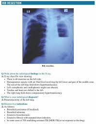Rib Resection Radiology Human Anatomy And Physiology Radiography Student