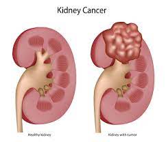 Some people with urethral cancer don't have any symptoms, but most do. Kidney Cancer Diagnosis Portland Oregon City Cancer Treatment