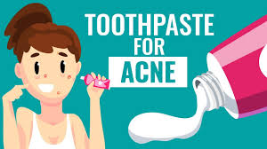 Is Using Toothpaste For Acne Safe Know The Truth Youtube