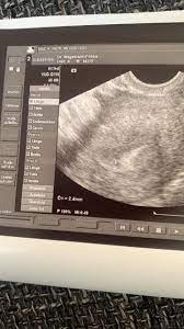 Ultraschall 4 5ssw Gesundheit Und Medizin Schwangerschaft