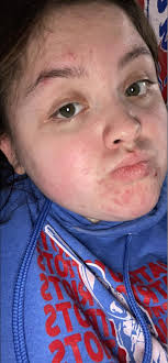 Natural remedies for acne