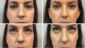 All About Under Eye Filler | Restylane, Before & After Photos, Cost