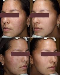 Redness down. Texture smoother. Breakouts calmer. What a difference  consistent care makes 🤍 #katierileyskincare #scottsdaleacneexpert #facial  #scottsdaleacne #scottsdaleacneclinic #scottsdaleacnespecialist #acnesafe  #porecloggingingredients #acne ...