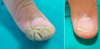The largest measured 4.6 cm in diameter. Spontaneous Regression Of A Recalcitrant Wart After Bivalent Papillomavirus Vaccination The Journal Of Pediatrics