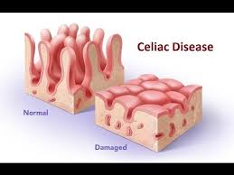 Celiac.com was the first web you've found your celiac tribe! Celiac Disease Youtube