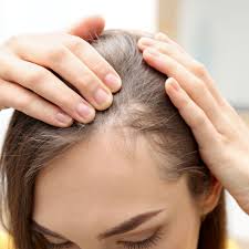 After you have given birth, the excess hair that was not shed during pregnancy women tend to find that their hair stops shedding and as a result becomes thicker. Can Women Use Minoxidil Usage And Possible Side Effects Roman Healthguide
