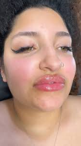 Summer refresh masterpiece…chef’s kiss 👌🥰, #lips #lipfillers #lipfiller  #beforeandafter