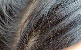 Lice Symptoms You Need To Be Aware Of