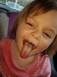 Ever get an obnoxious canker sore? Mouth Ulcers In 2yr Old