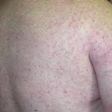 Swollen lymph nodes (lymph glands). Diffuse Maculopapular Rash Associated With West Nile Virus Infection Download Scientific Diagram