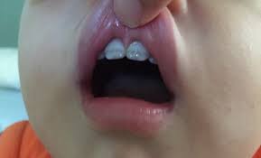 Baby Teeth Discoloration Babycenter