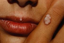 مرض الثآليل مسبباته وأعراضه وكيفية الوقاية منه الجمال نت