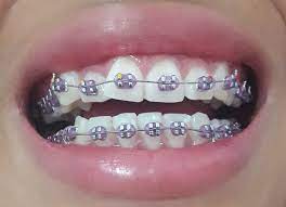 I Got Them Now Im So Happy But During My Sleep And When I Woke Up I Couldnt Move My Teeth Coz It Hurts So Bad Im Cryi Braces Colors Cute