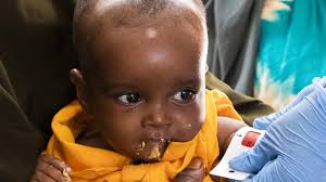 Inside the Somalian hospitals treating malnourished children during drought  crisis