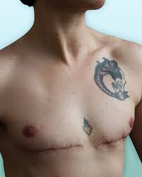Image result for Mastectomy