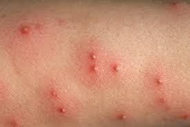 Mosquito bites are more common during the are you feeling itchy or tingling all over the body? Weird Skin Reactions