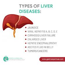 Liver Tumor Symptoms And Risk Factors Posts By North