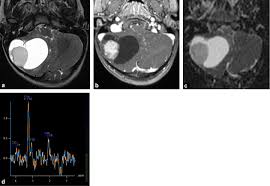 École doctorale des science de la vie et de la santé spécialité biologie cellulaire et physiopathologie. Tumeurs Cerebrales Particularites Chez L Enfant Sciencedirect
