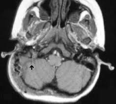 However, reports on the morphometric analysis of this structure are lacking in the literature. Imaging Of Complications Of Acute Mastoiditis In Children Radiographics