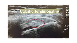 Image result for Rotator Cuff Calcification