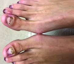 Image result for Onycholysis feet