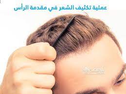 علاج لانبات الشعر في مقدمة الراس