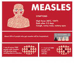 Measles And Measles Prevention | Let's Talk Science