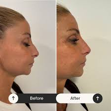 🇬🇧 The same-day result of the nose filler procedure I performed