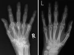 Image result for XRay Changes in Rheumatic Conditions