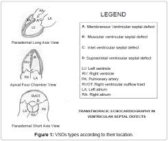 Image result for Ventricular Septal Defect