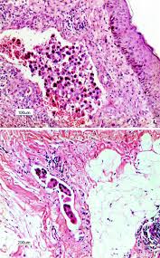 If the pathology results show that the skin and dermal lymphatics of the breast skin contain breast cancer cells, this confirms it is inflammatory breast cancer. Pathology Of Inflammatory Breast Cancer Springerlink