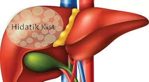 Check spelling or type a new query. Hidatik Kistte Ameliyatsiz Tedavi