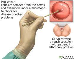 Your doctor will talk to you about the risk of the cancer coming back. Cervical Cancer Medlineplus Medical Encyclopedia