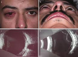 Image result for Proptosis