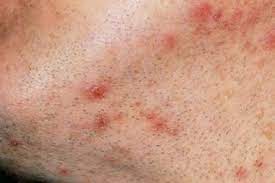 They look like small red dots on your skin, roughly the size of a pimple, and can become infected. Ingrown Hairs Nhs