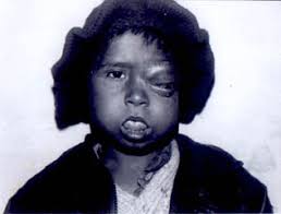 Incomplete Beckwith-Wiedemann Syndrome in a Child with Orbital  Rhabdomyosarcoma