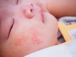 Maybe you would like to learn more about one of these? Does My Baby Have Acne Or A Rash Diagnosis And Treatment