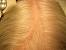 Ringworm In Scalp Hair Loss