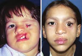 PEDIATRIC/CRANIOFACIAL