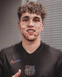 PAU “CHUKY” CUBARSÍ 😳 Así quedó Pau Cubarsí del FC Barcelona tras recibir  una dura entrada con los tacos al rostro en el partido de hoy frente al  Estrella Roja por la