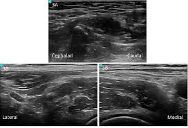 Check spelling or type a new query. Control Hip Fracture Pain Without Opioids Using Ultrasound Guided Fascia Iliaca Compartment Block Acep Now