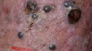 Signs of skin cancer may appear anywhere on your body. Symptoms And Pictures Of Stage 4 Melanoma