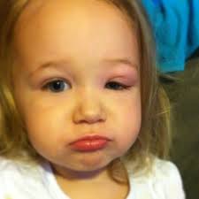 Mosquito bite on eyelid baby. Swollen Eyes In Babies New Kids Center