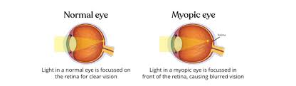 Image result for Myopia