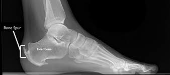 Stabilize the heel with orthotics the first line of treatment for achilles bone spur is to see exactly why you are having this problem! Achilles Tendinitis Orthoinfo Aaos