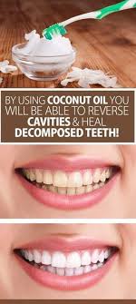By Using Coconut Oil You Will Be Able To Reverse Cavities And Heal Decomposed Teeth Coconut Oil For Teeth Heal Cavities Reverse Cavities